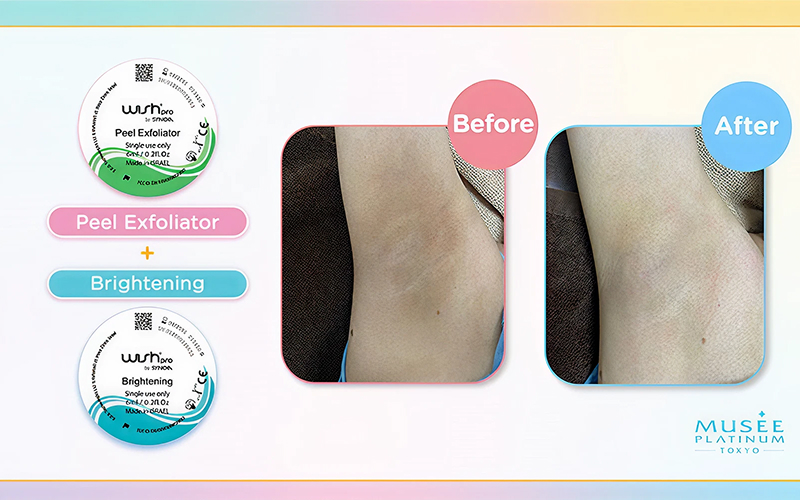 Before and after results of Musee Platinum underarm brightening