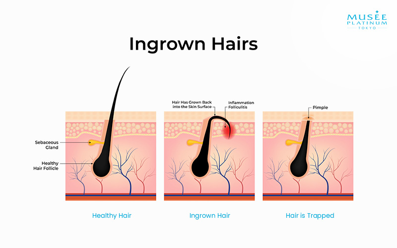 infographics-ingrown-hairs