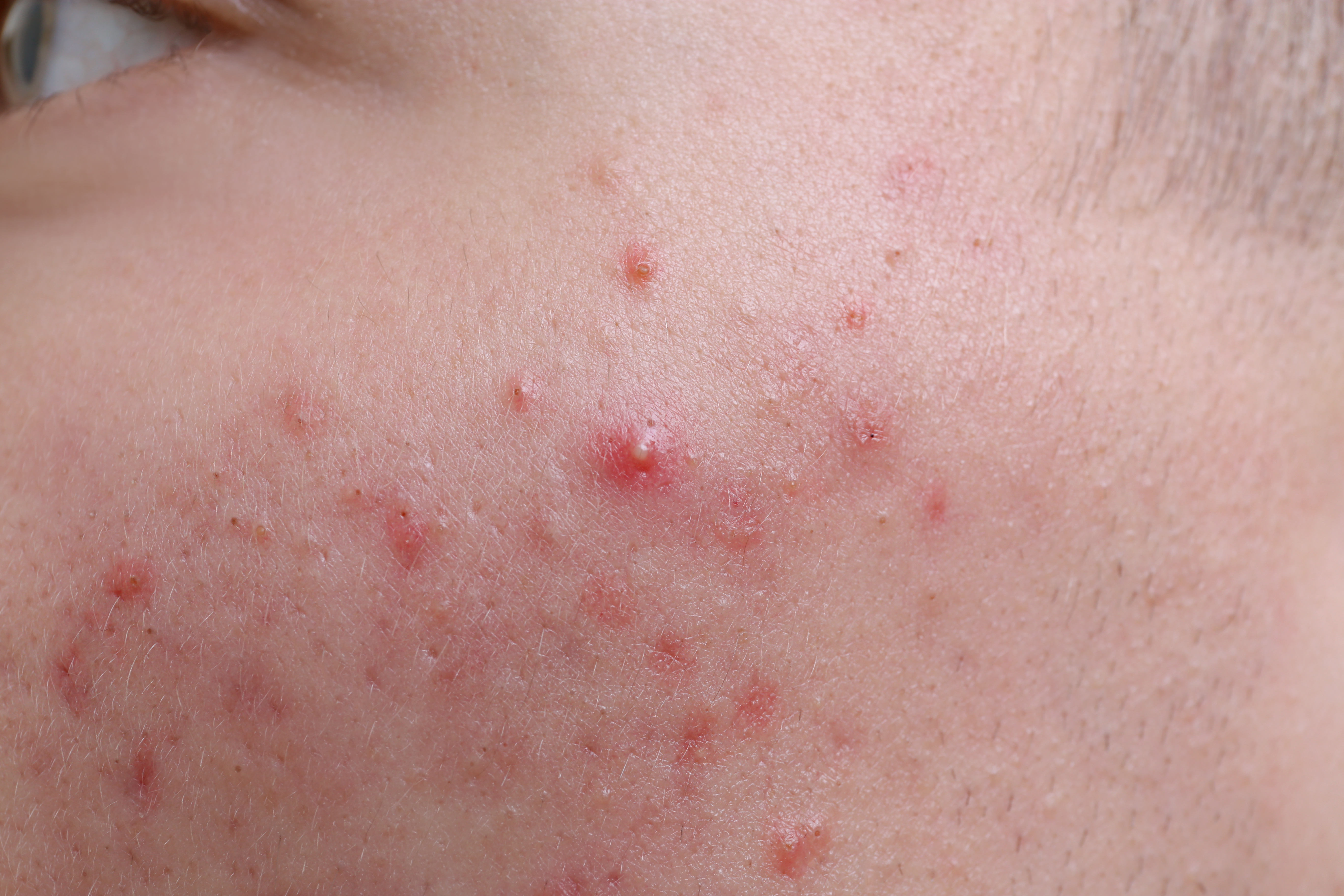 Close-up of acne breakouts on skin